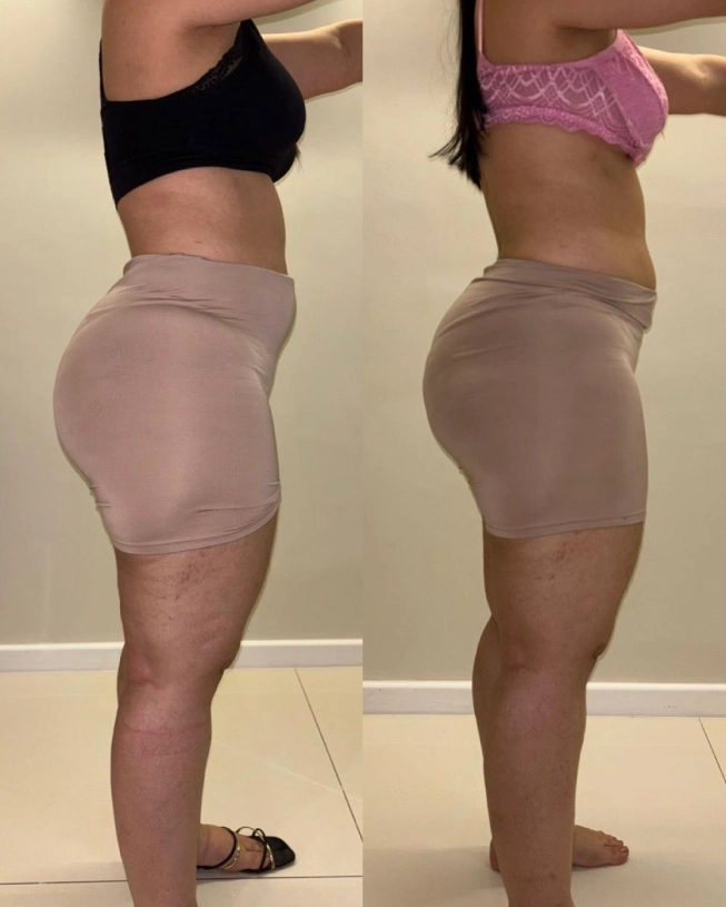 Before-and-after side view of a woman with lipedema showing reduced volume in the hips and thighs
