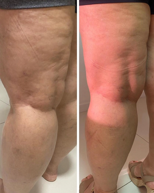 Before-and-after comparison of a woman with lipedema showing smoother skin on the thighs