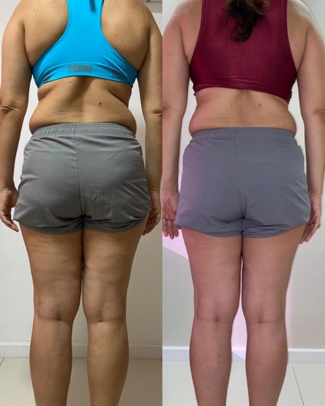 Before-and-after rear view of a woman with lipedema showing reduced leg volume